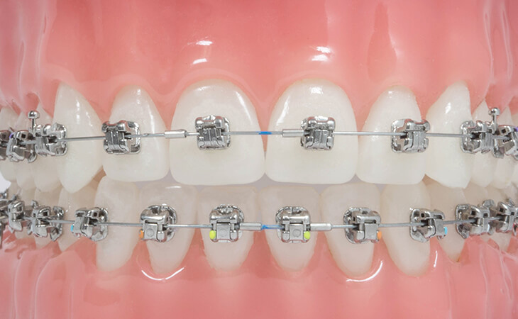 Aparat Dentar Damon Q2 Typodont