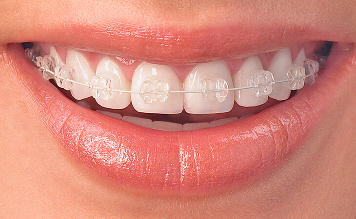 Aparat dentar fix safir • Aparat Ortodontic Safir • The Smile Space