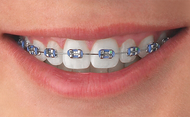 aparat dentar metalic fix ortodontic