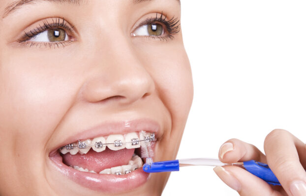 10 sfaturi pentru îngrijirea aparatului dentar fix